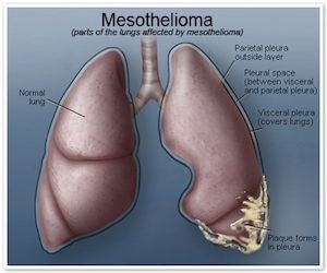 epithelioid mesothelioma sacaramento